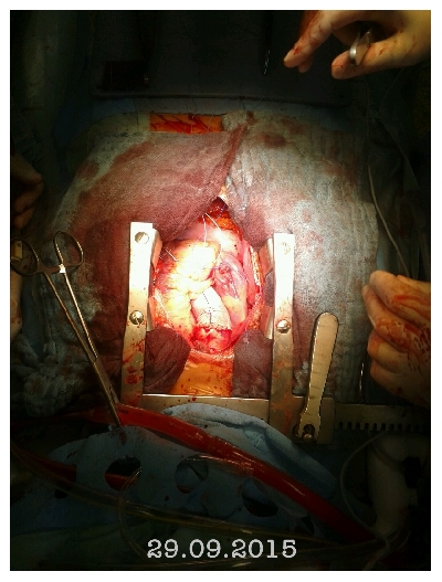 Foto del mio cuore a termine intervento